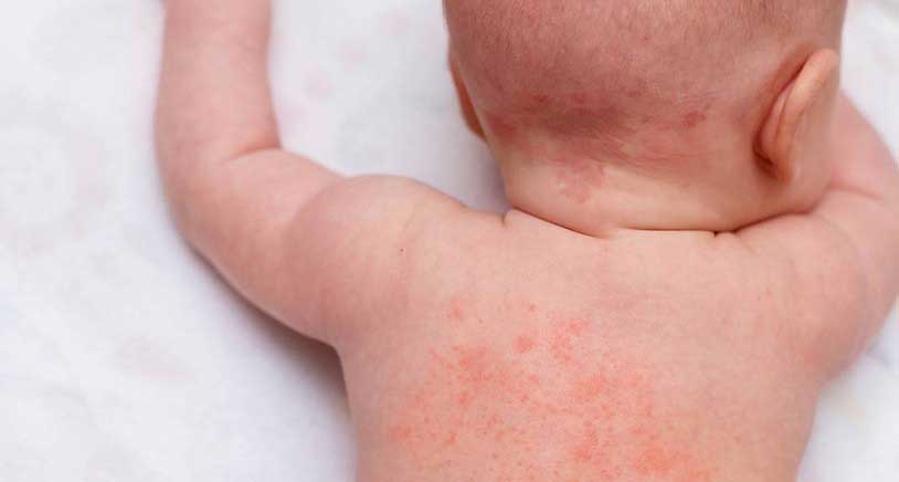 Common Rashes in Children -- Yeung Ho Hong,楊浩康