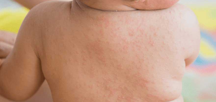 What is Roseola Infantum (嬰兒玫瑰疹) ? -- Yeung Ho Hong,楊浩康