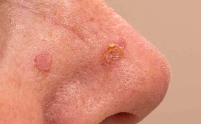 What are the treatment options for actinic keratosis? -- Yeung Ho Hong,楊浩康