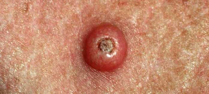 What is a keratoacanthoma (角化棘皮瘤) ? -- Yeung Ho Hong,楊浩康