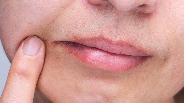 Angular Cheilitis 口角炎 -- Yeung Ho Hong,楊浩康